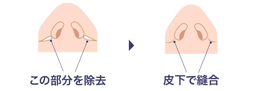 小鼻縮小術（鼻翼縮小）